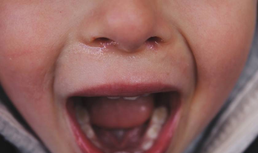 Tips to Prevent Tooth and Mouth Injuries